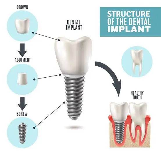 teeth-whitening-thumbnail