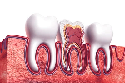 teeth-whitening-thumbnail