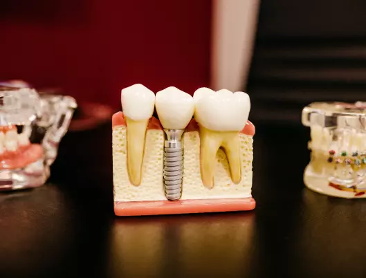 teeth replica