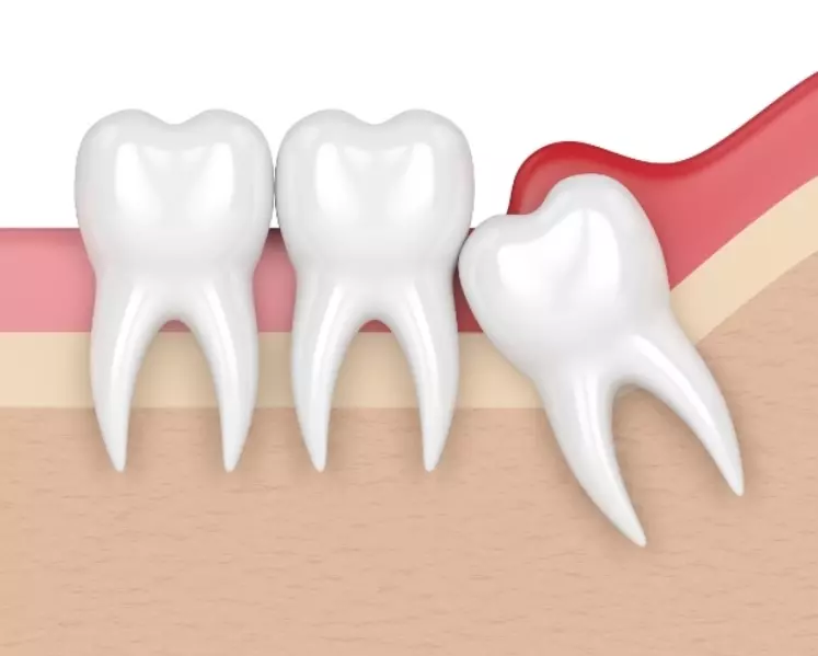 wisdom teeth