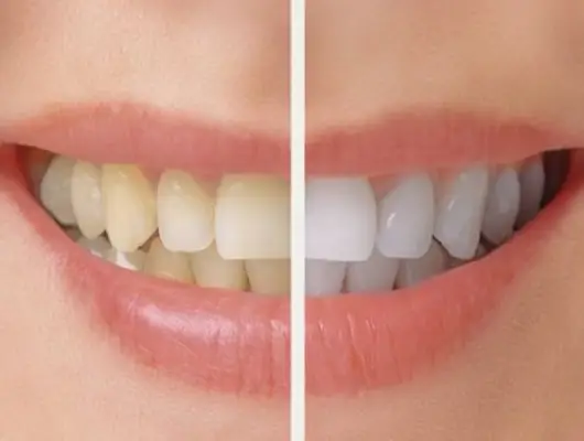 teeth whitening