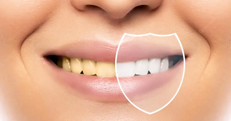 teeth whitening result